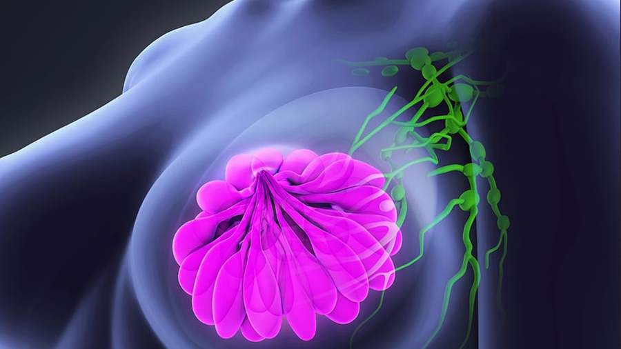 Endometriózis – Wikipédia